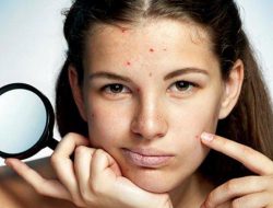 Dampak Kulit Berjerawat Dapat Mempengaruhi Kesehatan Mental