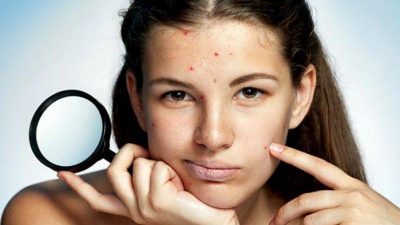 Ilustrasi Wajah Berjerawat